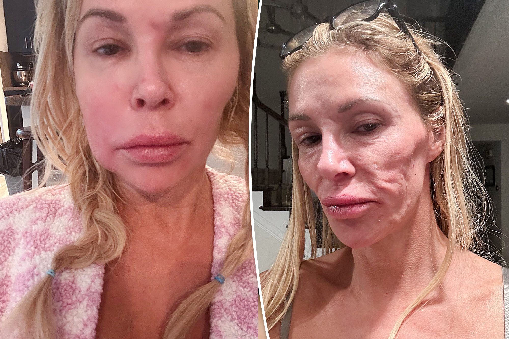 Brandi Glanville says unexplained facial lumps are inflicting ‘acidic’ and ‘foul-tasting drainage’ to eat away at tooth